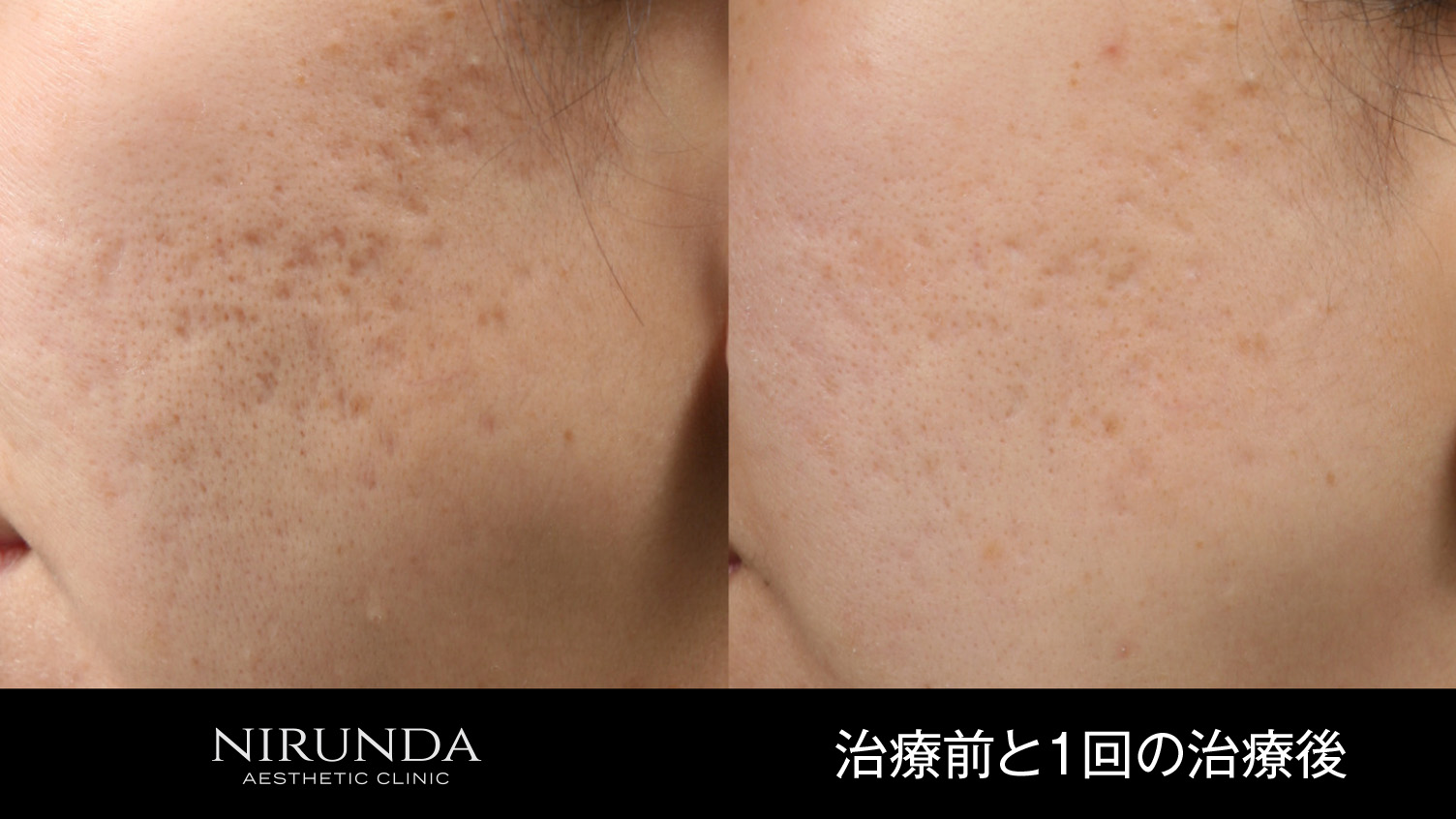 5 Steps of Potenza Microneedling